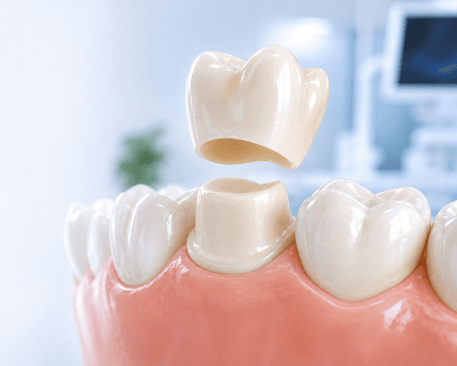 Dental crown being placed on a prepared tooth