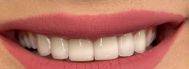 Natural-looking dental restoration result at Dentalmed