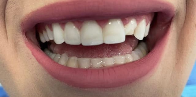 Teeth before crown treatment