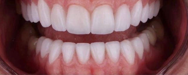 Teeth after veneer treatment
