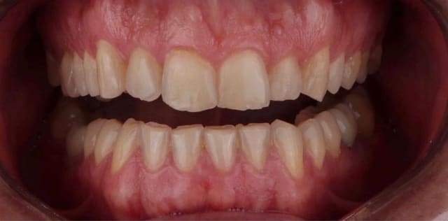Teeth before veneer treatment